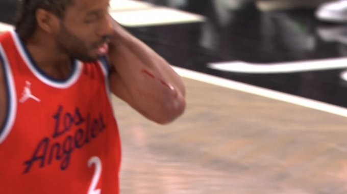 觸目驚心！小卡手臂被劃出一道長長的血痕 去場邊及時止血處理